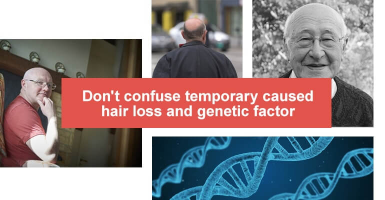 genetic hair loss