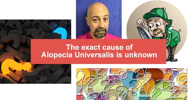 Alopecia Universalis